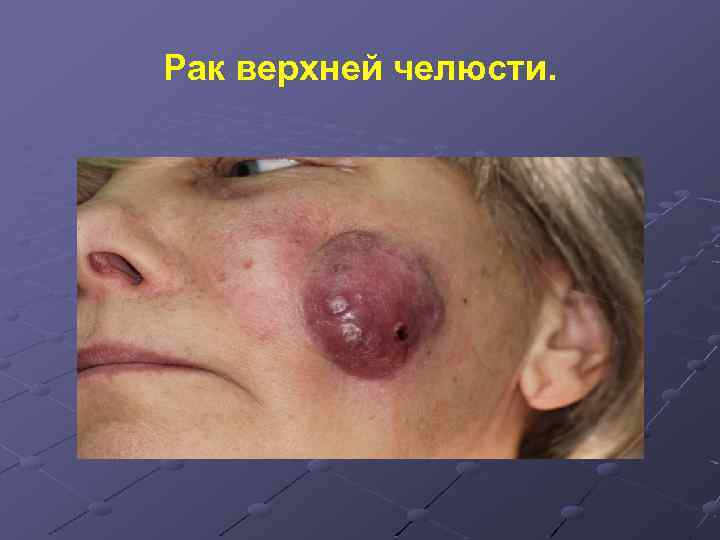 Рак верхней челюсти. 