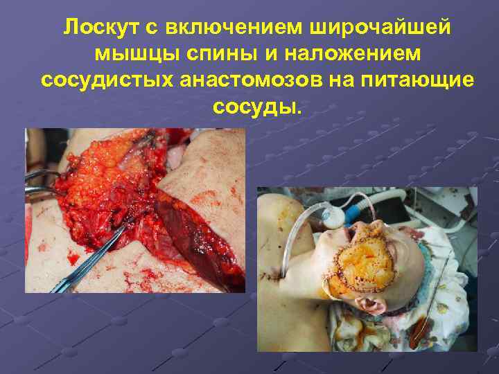 Лоскут с включением широчайшей мышцы спины и наложением сосудистых анастомозов на питающие сосуды. 