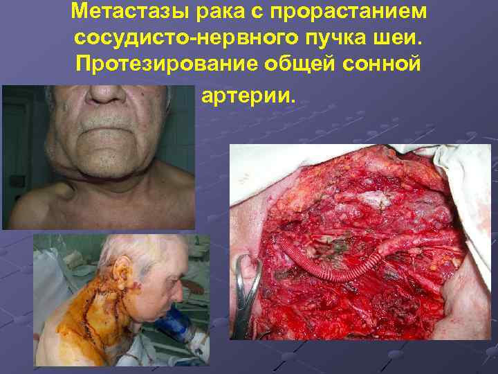 Метастазы рака с прорастанием сосудисто-нервного пучка шеи. Протезирование общей сонной артерии. 