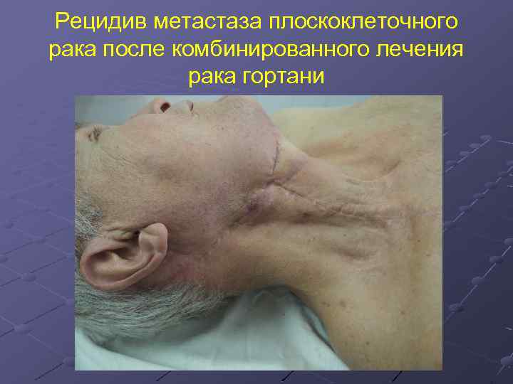 Рецидив метастаза плоскоклеточного рака после комбинированного лечения рака гортани 