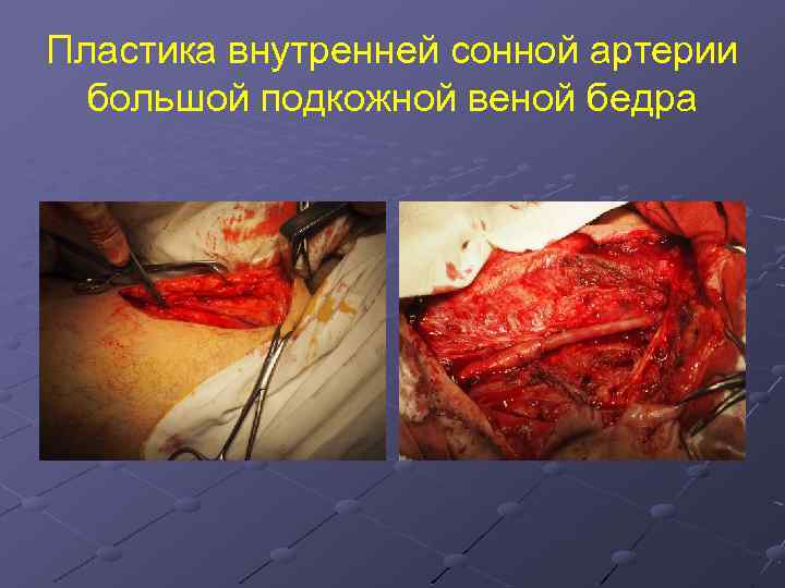 Пластика внутренней сонной артерии большой подкожной веной бедра 