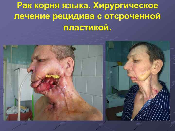 Рак корня языка. Хирургическое лечение рецидива с отсроченной пластикой. 