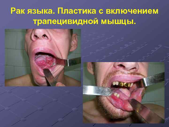 Рак языка. Пластика с включением трапецивидной мышцы. 