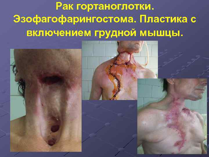 Рак гортаноглотки. Эзофагофарингостома. Пластика с включением грудной мышцы. 