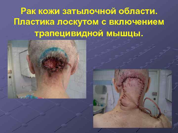 Рак кожи затылочной области. Пластика лоскутом с включением трапецивидной мышцы. 