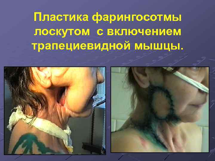 Пластика фарингосотмы лоскутом с включением трапециевидной мышцы. 