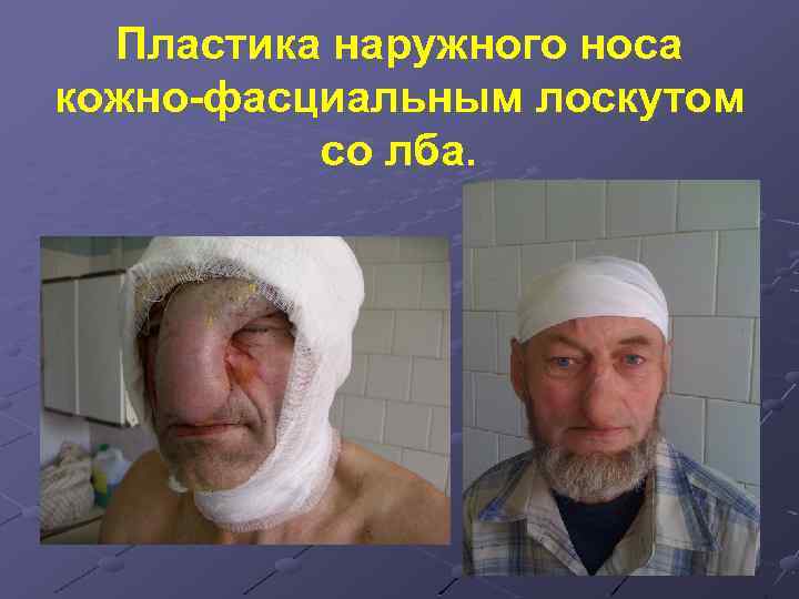 Пластика наружного носа кожно-фасциальным лоскутом со лба. 