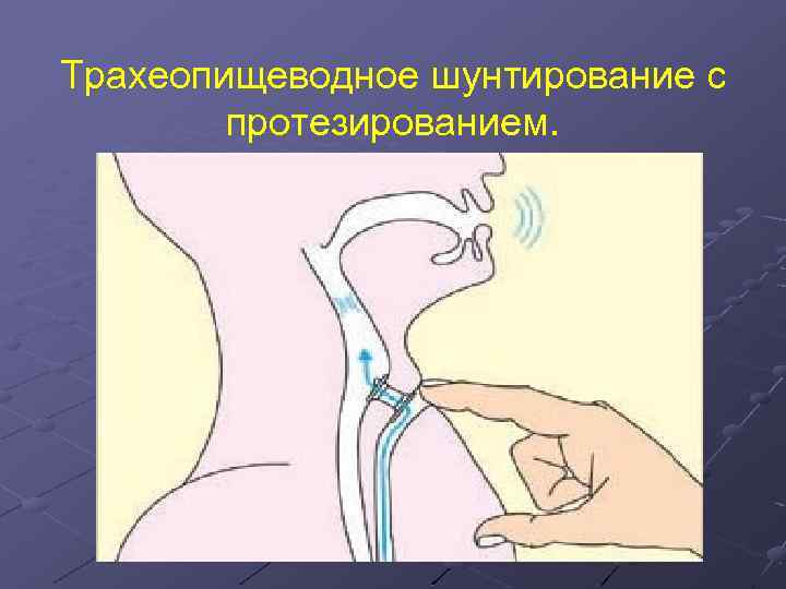 Трахеопищеводное шунтирование с протезированием. 