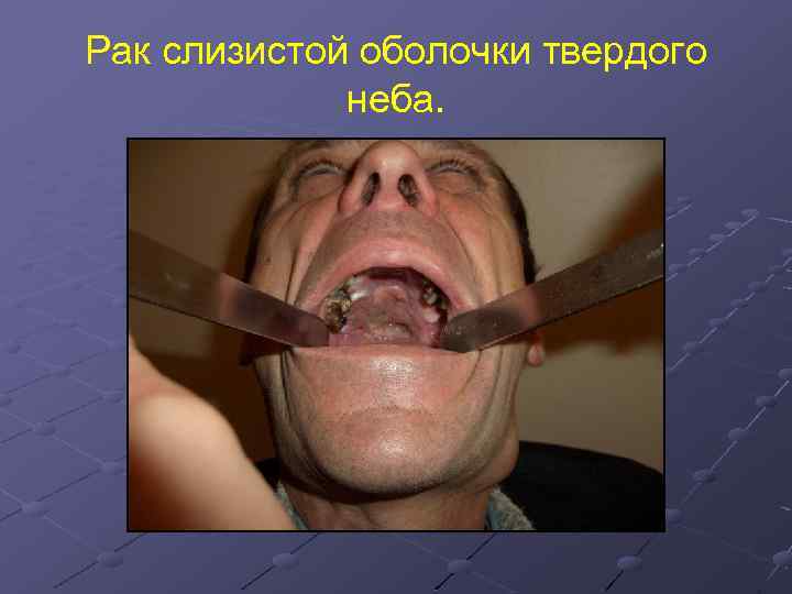 Рак слизистой оболочки твердого неба. 