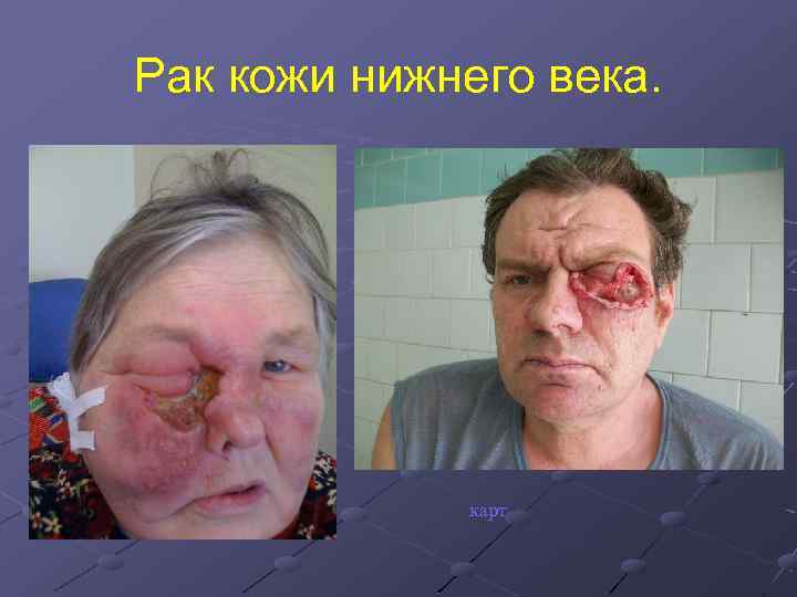 Рак кожи нижнего века. карт 
