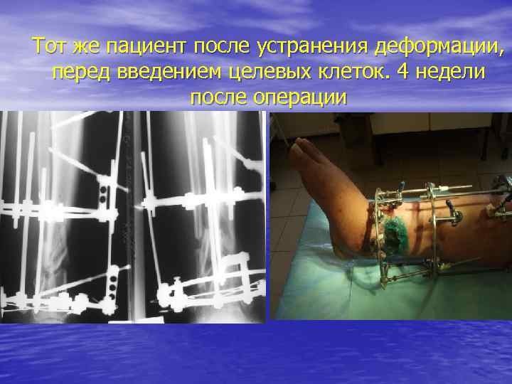 Тот же пациент после устранения деформации, перед введением целевых клеток. 4 недели после операции