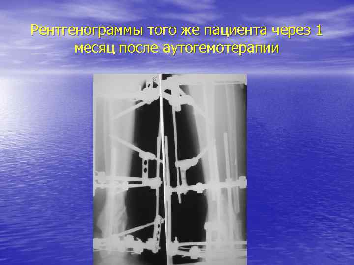 Рентгенограммы того же пациента через 1 месяц после аутогемотерапии 