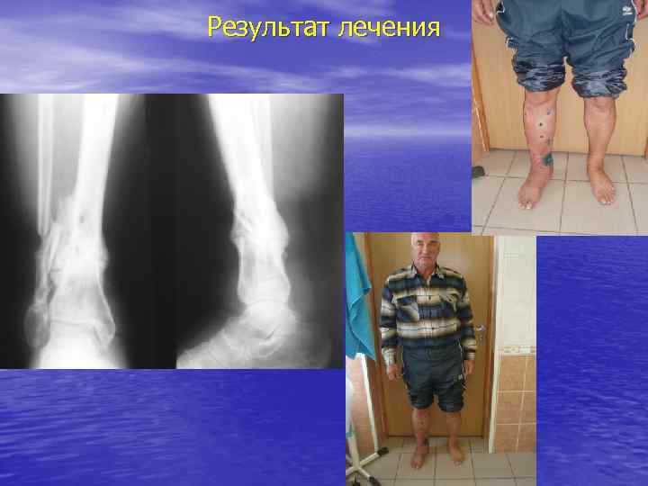 Результат лечения 
