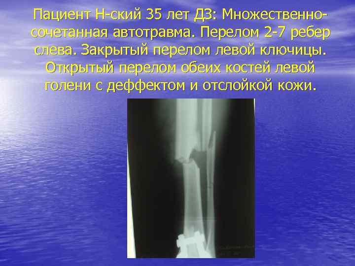Пациент Н-ский 35 лет ДЗ: Множественносочетанная автотравма. Перелом 2 -7 ребер слева. Закрытый перелом