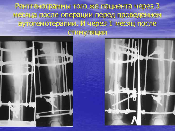 Рентгенограммы того же пациента через 3 месяца после операции перед проведением аутогемотерапии. И через