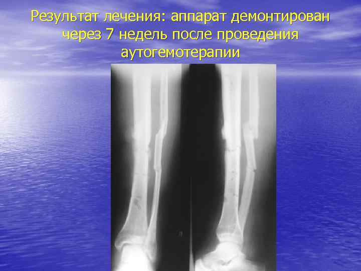 Результат лечения: аппарат демонтирован через 7 недель после проведения аутогемотерапии 