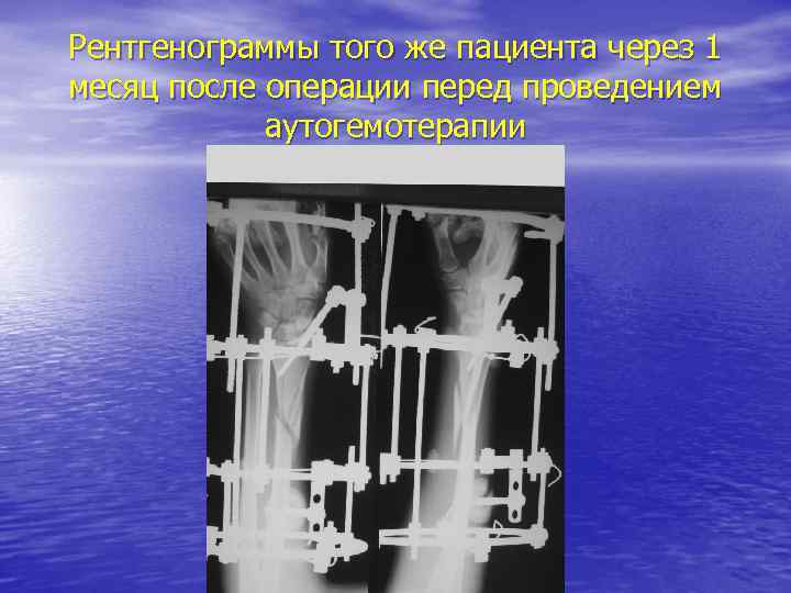 Рентгенограммы того же пациента через 1 месяц после операции перед проведением аутогемотерапии 
