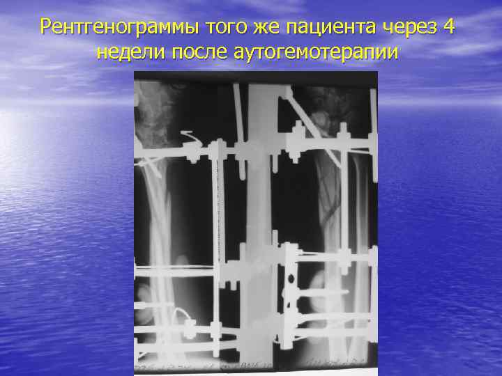 Рентгенограммы того же пациента через 4 недели после аутогемотерапии 