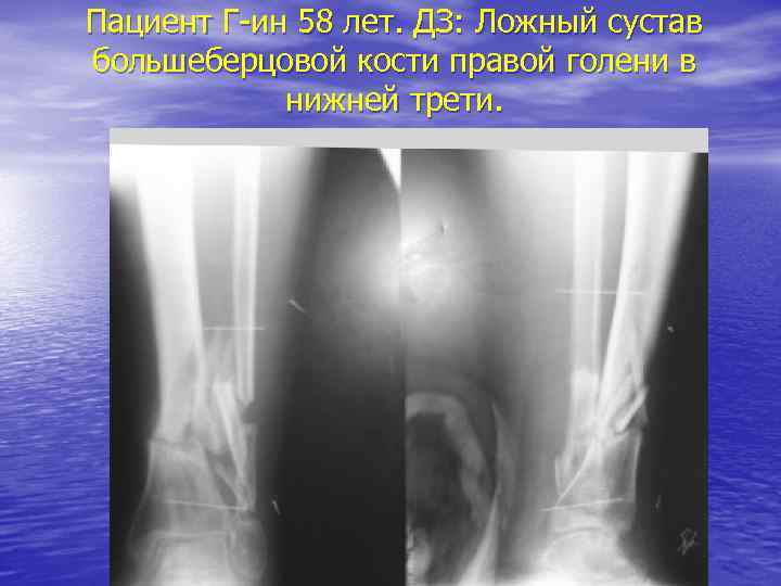 Пациент Г-ин 58 лет. ДЗ: Ложный сустав большеберцовой кости правой голени в нижней трети.