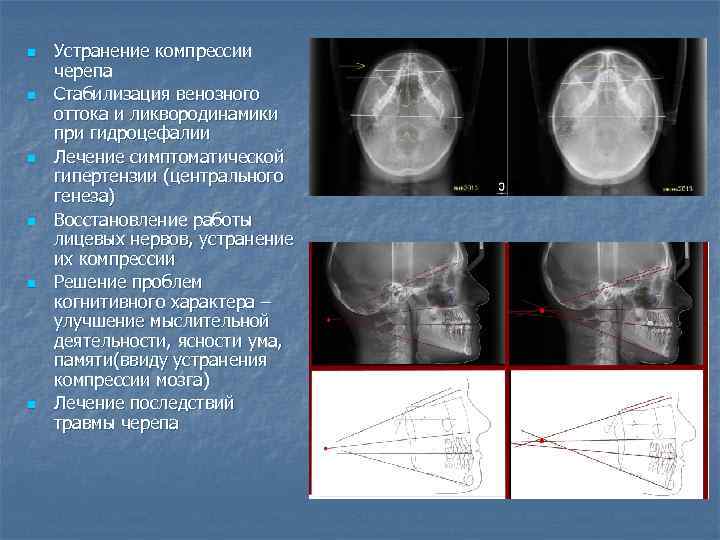 n n n Устранение компрессии черепа Стабилизация венозного оттока и ликвородинамики при гидроцефалии Лечение