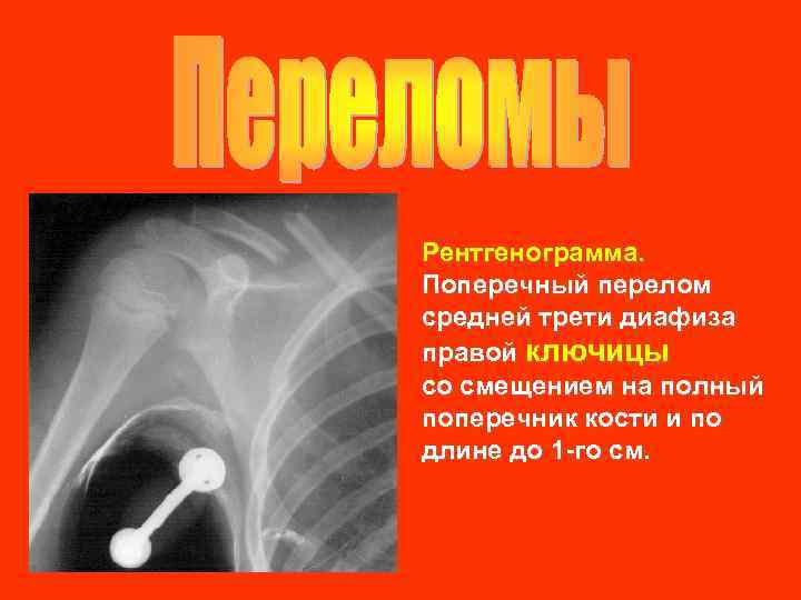 Рентгенограмма. Поперечный перелом средней трети диафиза правой ключицы со смещением на полный поперечник кости