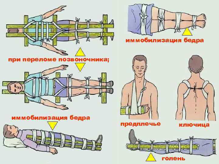 Матрас при переломе позвоночника