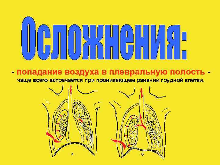 - попадание воздуха в плевральную полость чаще всего встречается при проникающем ранении грудной клетки.