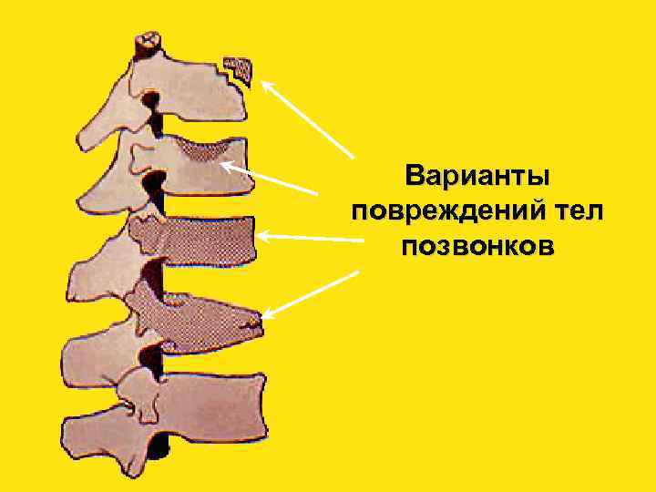 Перелом грудного отдела позвоночника. Клиновидные шейные позвонки. Повреждение тел позвонков. Клиновидный позвонок грудного отдела. Деформация позвонка по типу рыбьего.