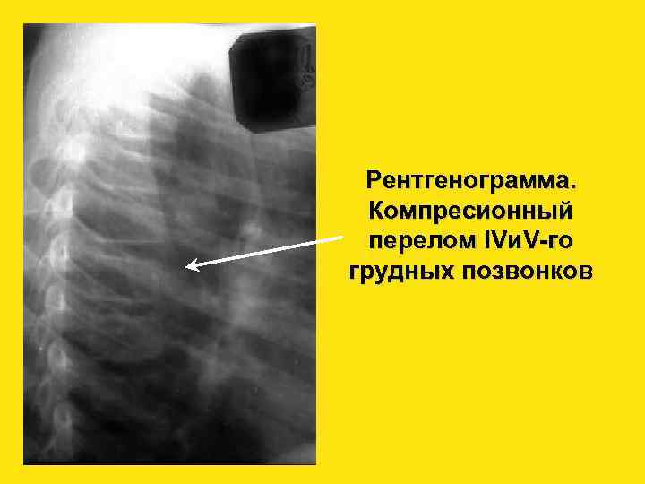 Рентгенограмма. Компресионный перелом IVи. V-го грудных позвонков 