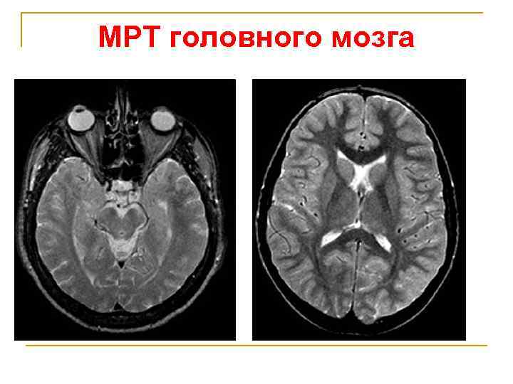 МРТ головного мозга 