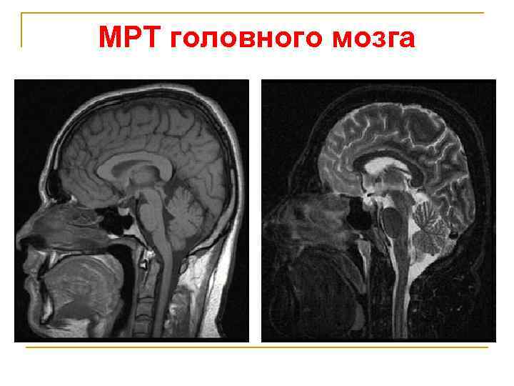 МРТ головного мозга 