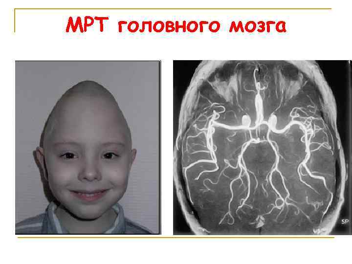 МРТ головного мозга 