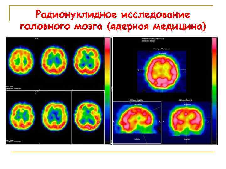 Радионуклидное исследование головного мозга (ядерная медицина) 
