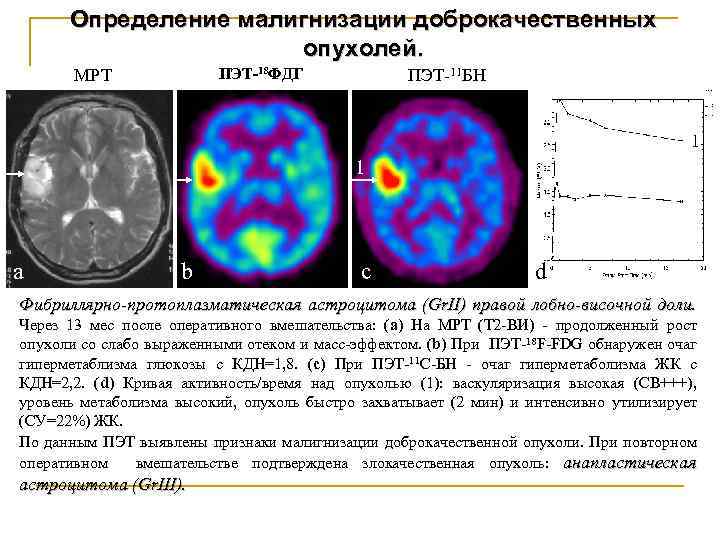 Определение малигнизации доброкачественных опухолей. ПЭТ-18 ФДГ МРТ ПЭТ-11 БН АЭСц. Г 1 1 а