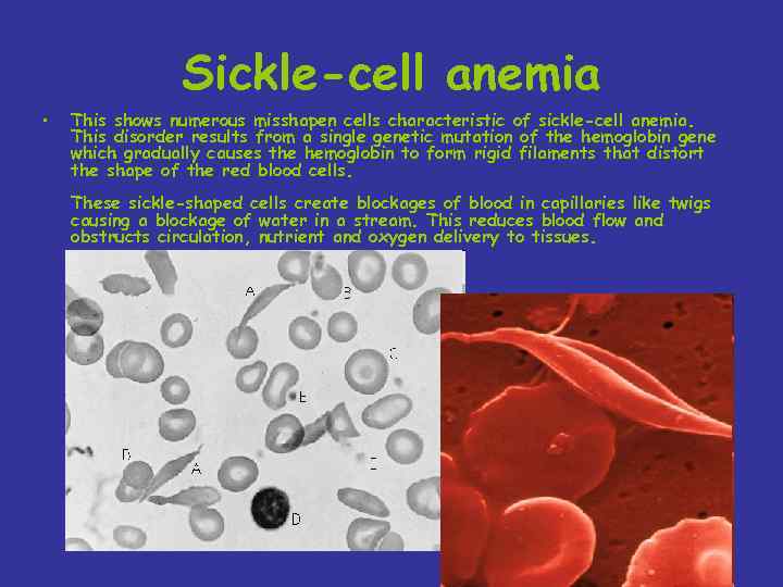 Sickle-cell anemia • This shows numerous misshapen cells characteristic of sickle-cell anemia. This disorder