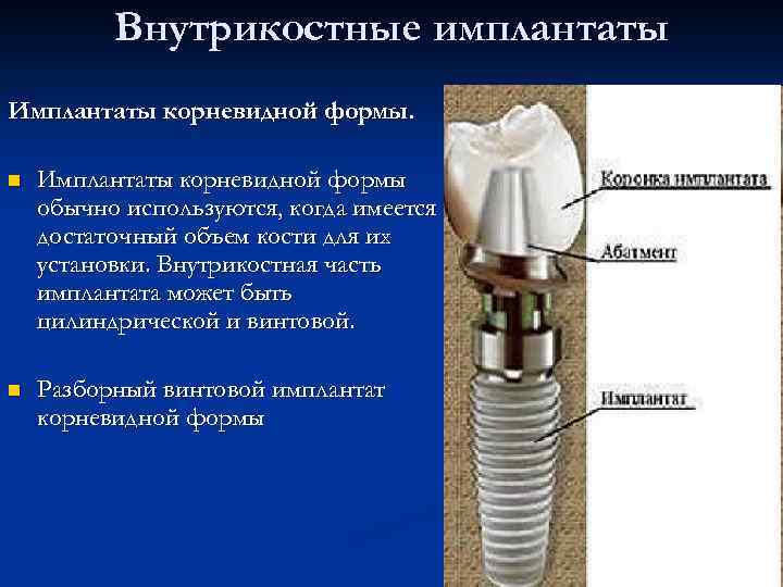 Дентальная имплантация презентация