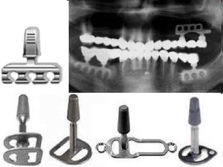 Кортикальный имплант. Внутрикостные пластиночные имплантаты. Субпериостальная имплантация. Внутрикостная дентальная имплантация ортодонтического импланта. Эндо-субпериостальная имплантация.