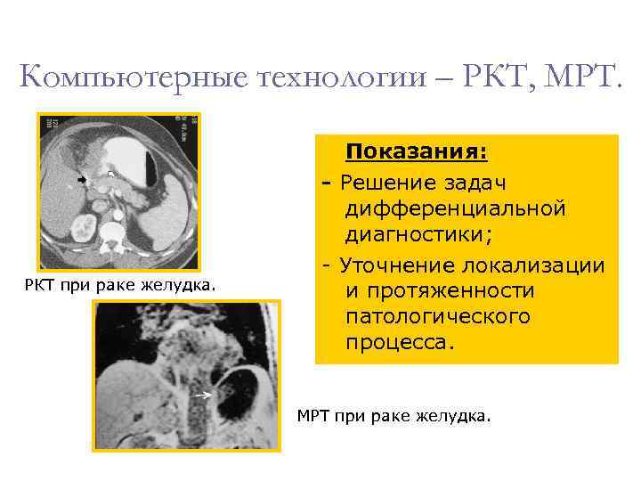 Компьютерные технологии – РКТ, МРТ. Показания: - Решение задач дифференциальной диагностики; - Уточнение локализации