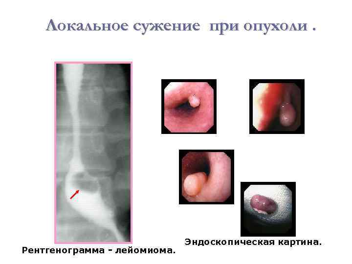 Локальное сужение при опухоли. Рентгенограмма - лейомиома. Эндоскопическая картина. 