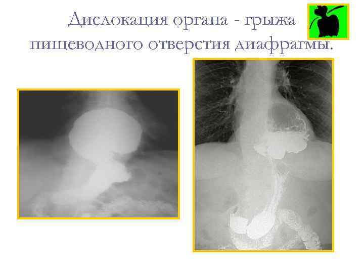 Дислокация органа - грыжа пищеводного отверстия диафрагмы. 