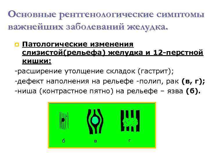 Основные рентгенологические симптомы важнейших заболеваний желудка. Патологические изменения слизистой(рельефа) желудка и 12 -перстной кишки: