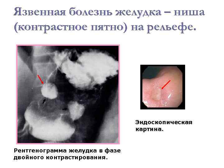 Целиакия эндоскопическая картина