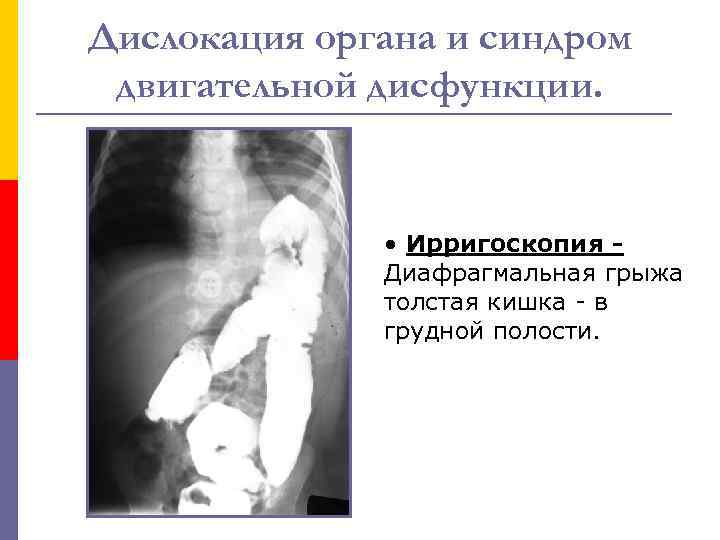 Дислокация органа и синдром двигательной дисфункции. • Ирригоскопия Диафрагмальная грыжа толстая кишка - в