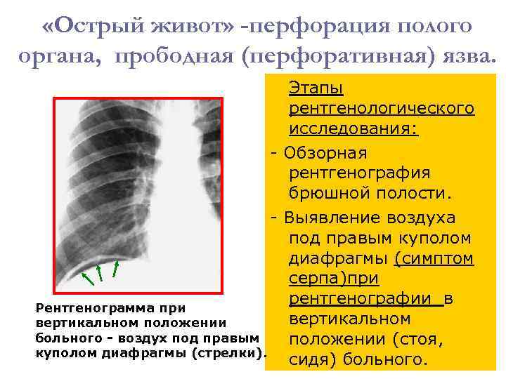 Прободение полого органа рентген схема