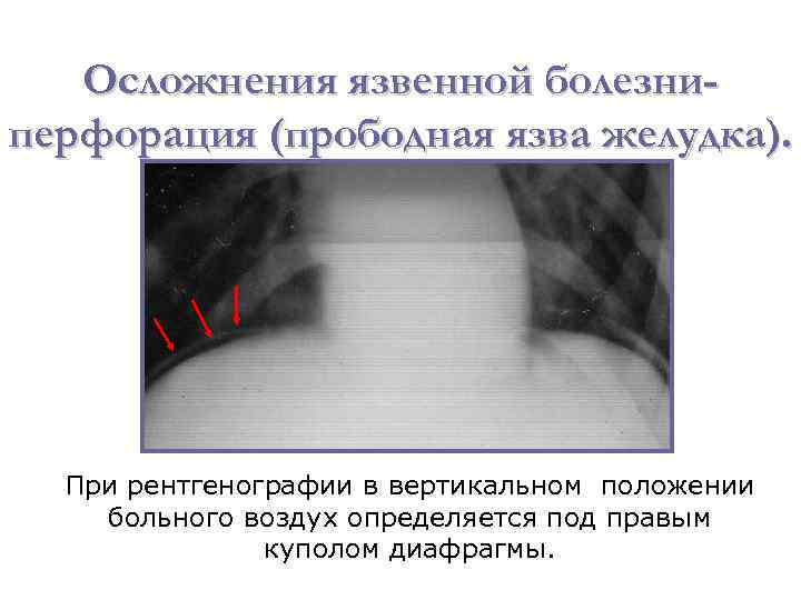 Осложнения язвенной болезниперфорация (прободная язва желудка). При рентгенографии в вертикальном положении больного воздух определяется