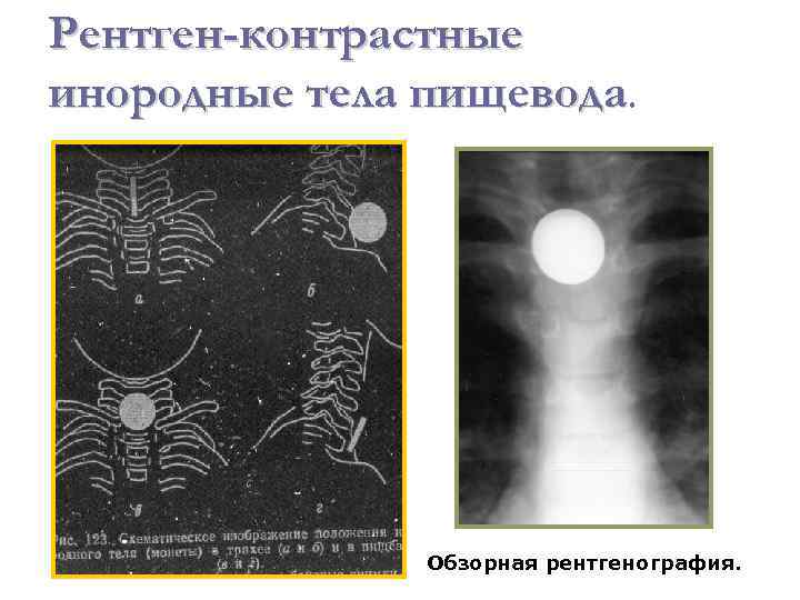 Инородное тело пищевода карта вызова скорой медицинской