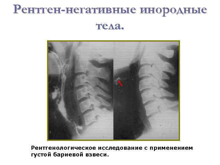 Рентген-негативные инородные тела. Рентгенологическое исследование с применением густой бариевой взвеси. 