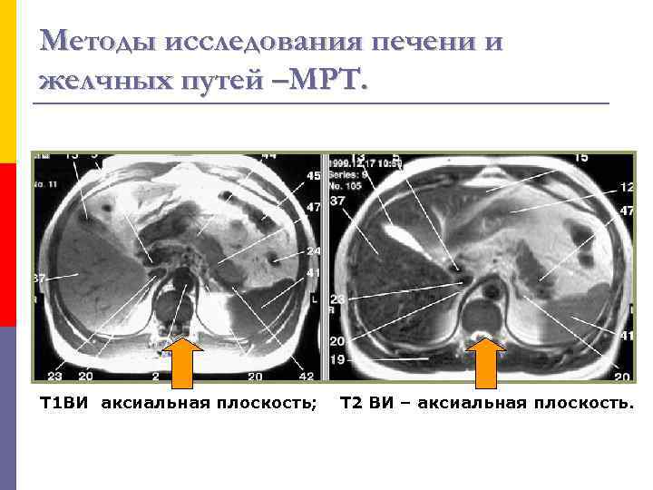 Методы исследования печени и желчных путей –МРТ. Т 1 ВИ аксиальная плоскость; Т 2