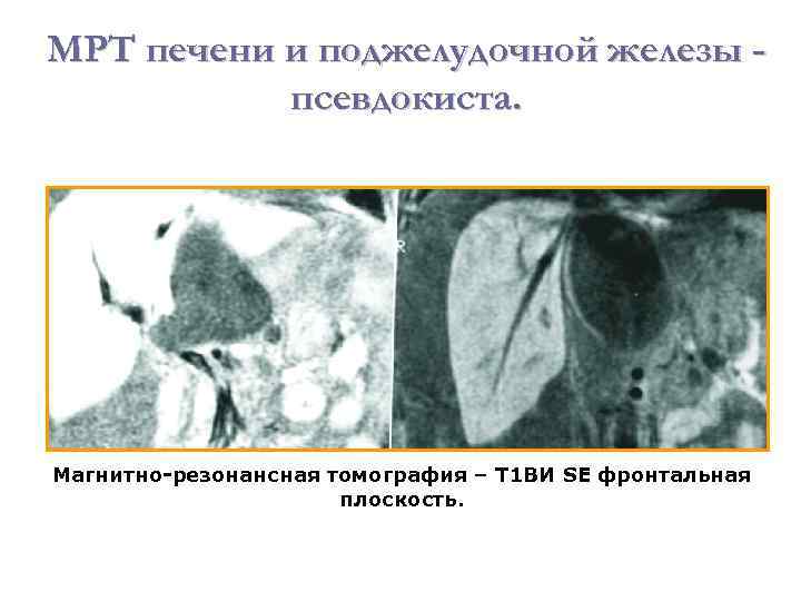 МРТ печени и поджелудочной железы псевдокиста. Магнитно-резонансная томография – Т 1 ВИ SE фронтальная