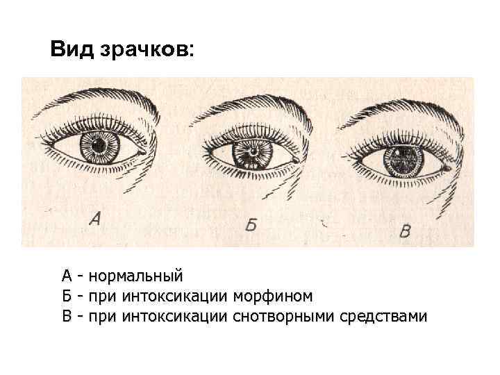 Вид зрачков: А - нормальный Б - при интоксикации морфином В - при интоксикации